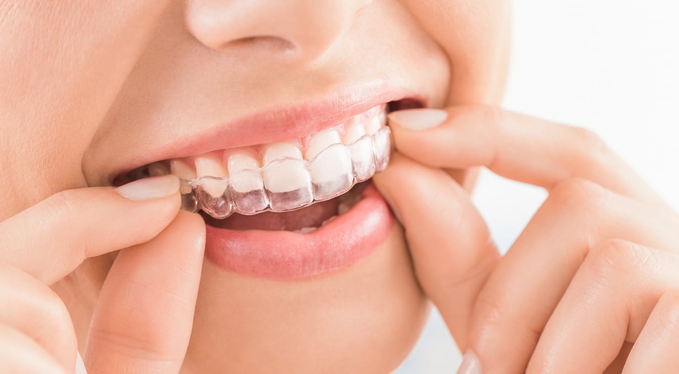 Teeth of a Woman Wearing Aligners  